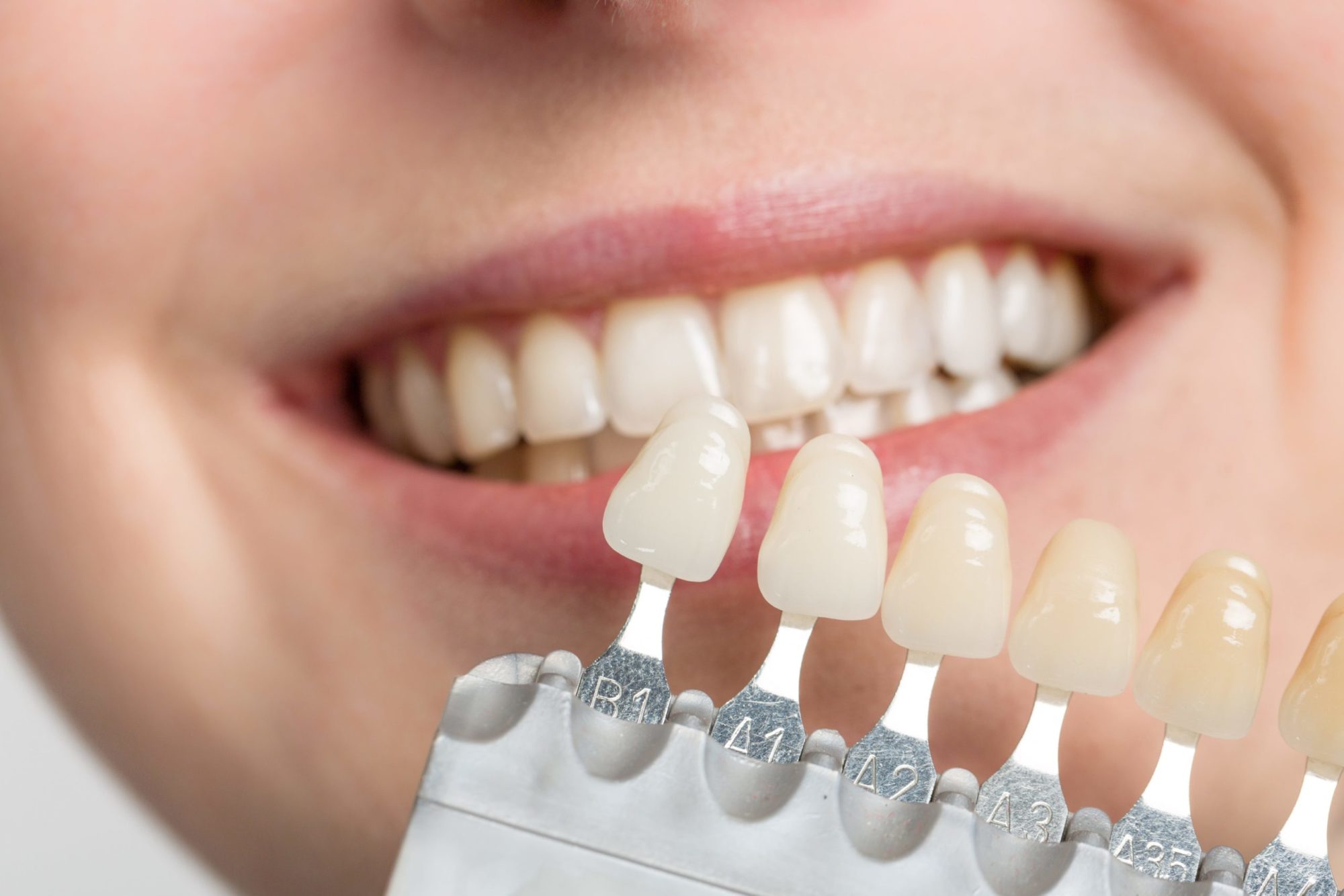 Featured image for “Dental Veneers”